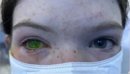 Doença deixa olho esverdeado e provoca dor intensa em pacientes na Austrália