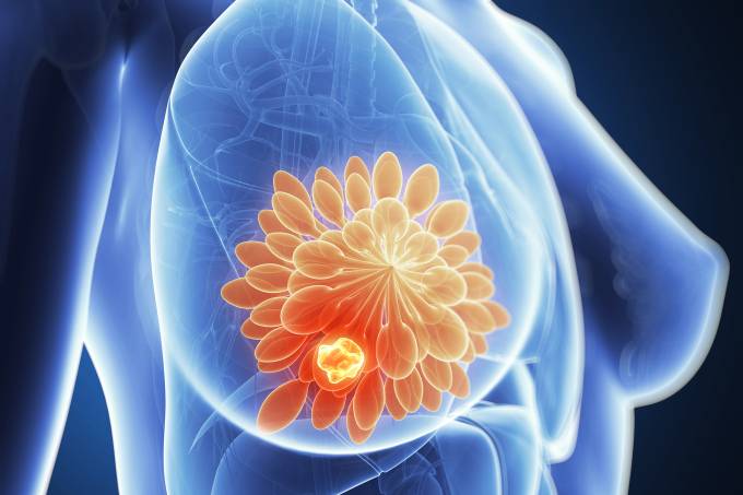 Brasileiros descobrem 6 novas mutações para câncer de mama e ovário
