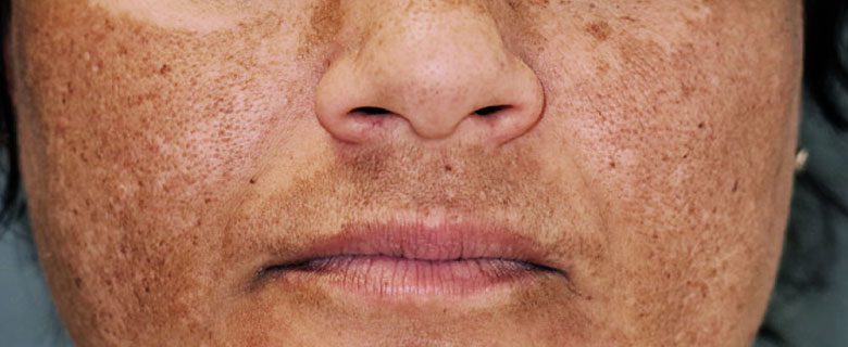 Melasma: 8 alimentos com compostos bioativos e ação fotoprotetora