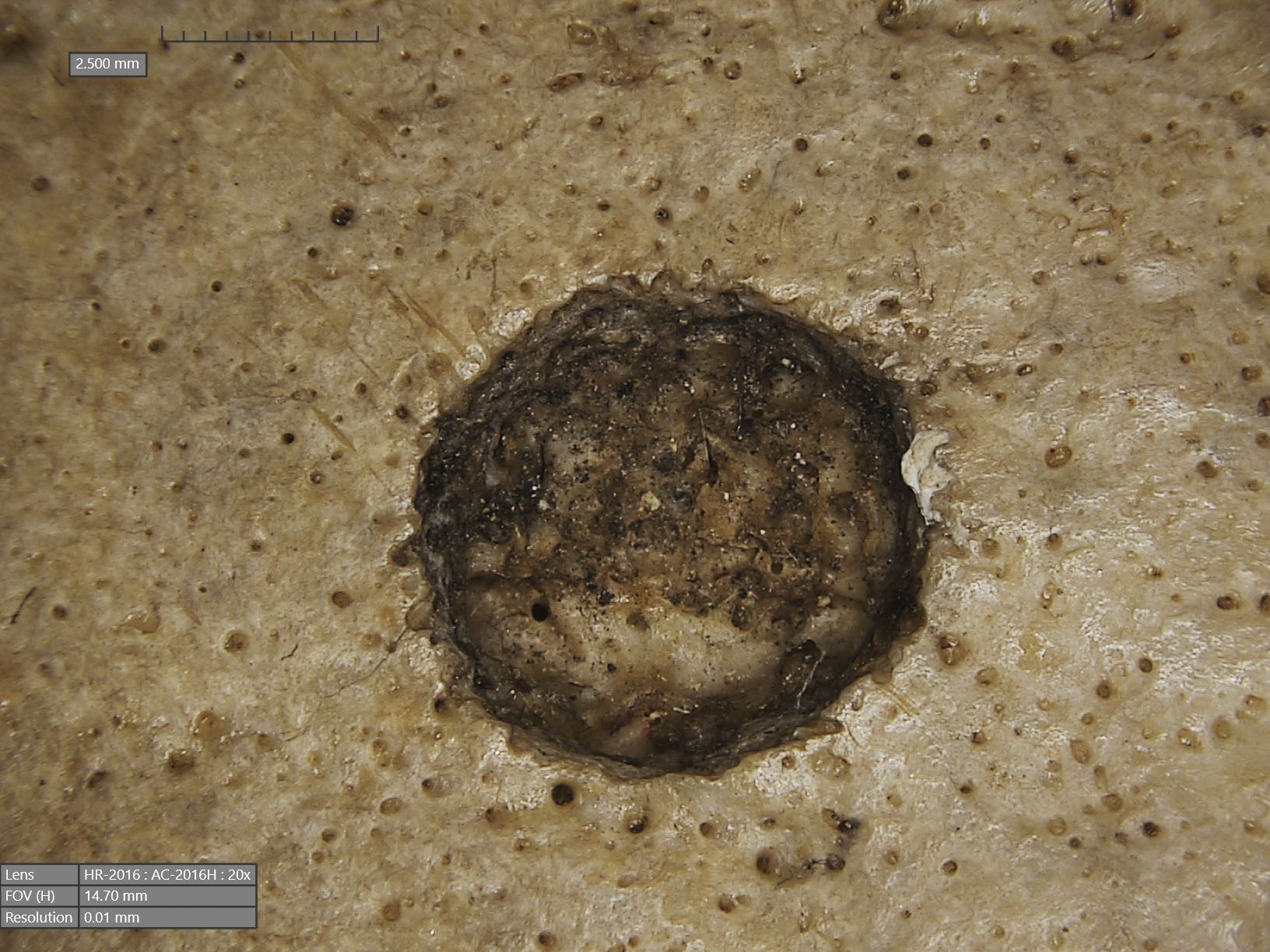  Remoção de tumor em crânio de 4 mil anos revela marco no tratamento de câncer 