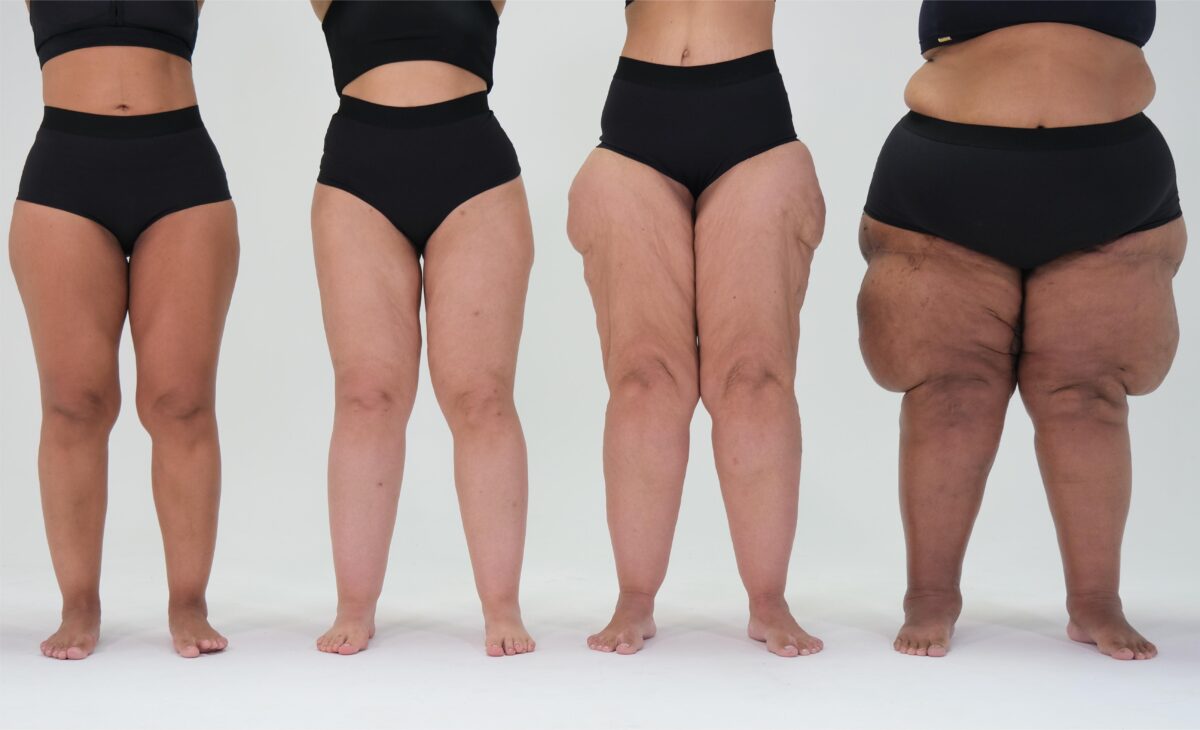 Estudo revela por que pacientes com lipedema têm dificuldade em ganhar massa muscular