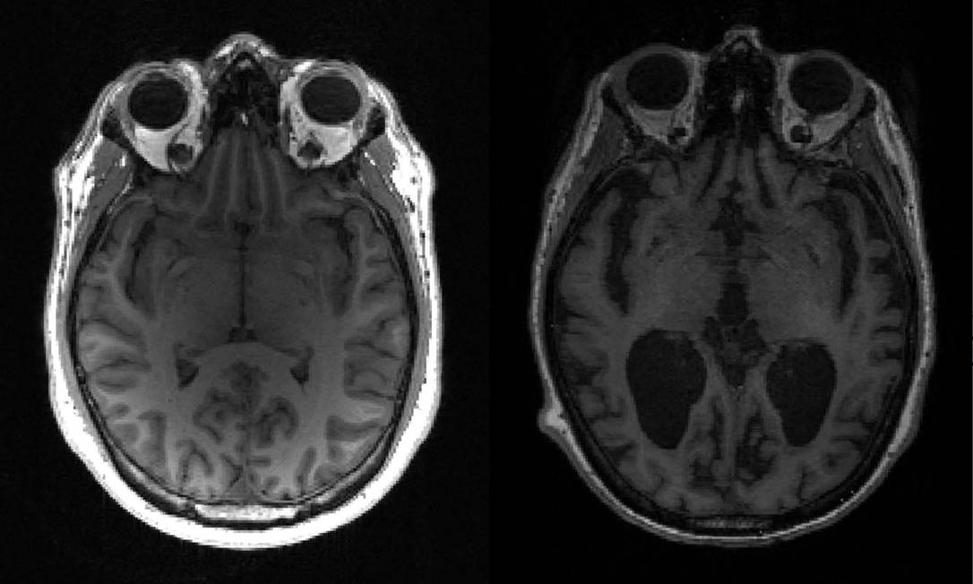 Vacina contra Alzheimer inicia fase de testes em humanos