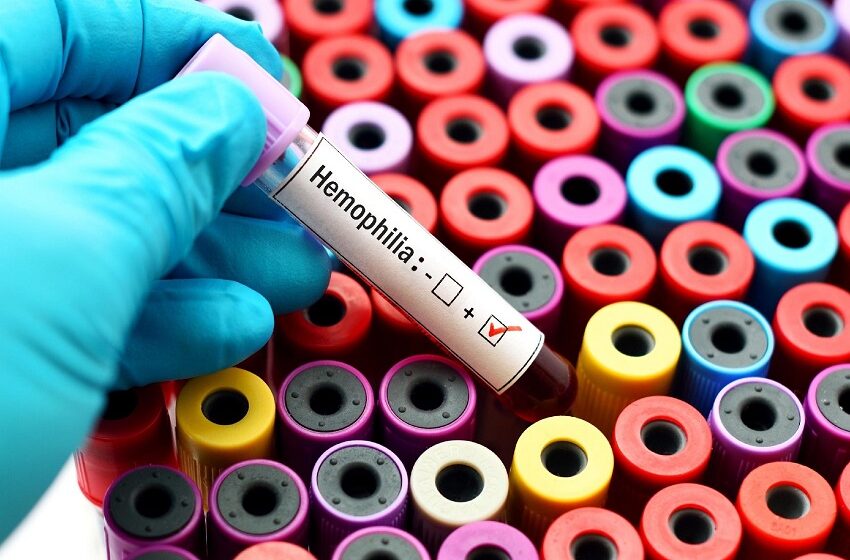  HU-Univasf diagnostica caso raro de hemofilia adquirida 