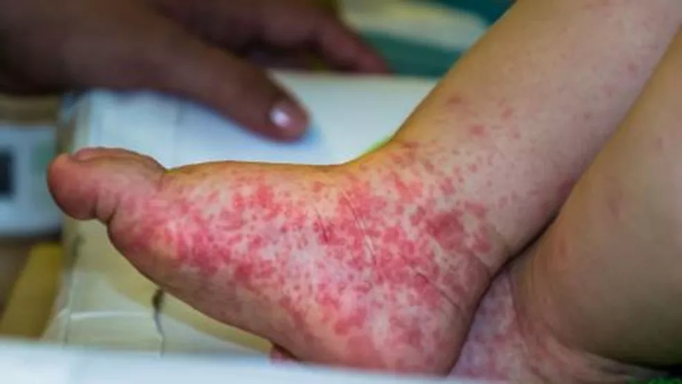 'Gripe do tomate': o que é o novo vírus identificado na Índia