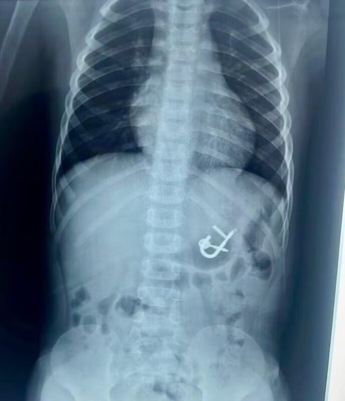 Criança de quatro anos é atendida em hospital após engolir cadeado com as chaves