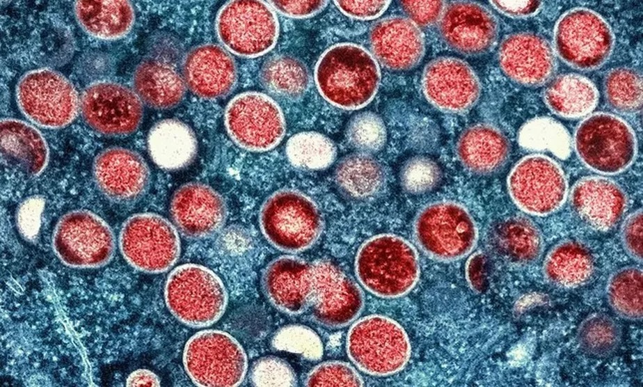 Varíola dos macacos: combate à doença não pode cometer o mesmo erro que na Aids, diz OMS
