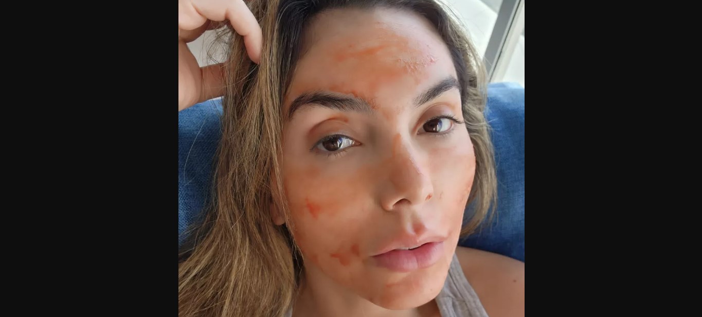 Sangue menstrual para a beleza da pele? Médicos desaprovam o hábito que virou febre nas redes, entenda