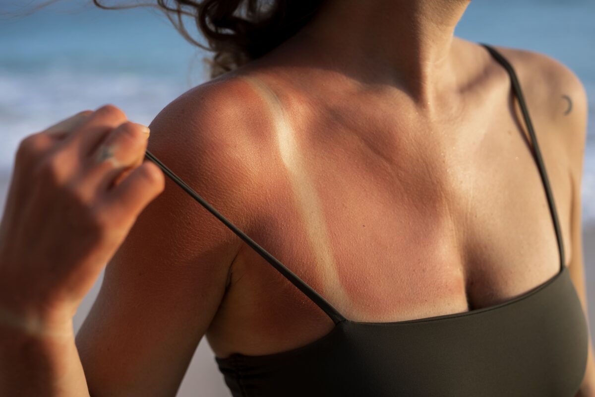 52% da Geração Z desconhecem riscos das queimaduras solares; veja como se proteger
