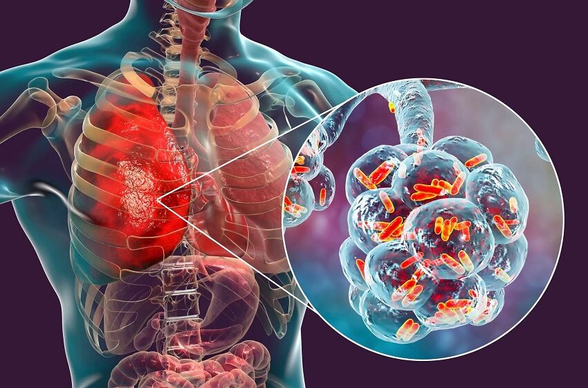  SUS: Internações por pneumonia geraram custo de R$ 381 milhões em 2025 