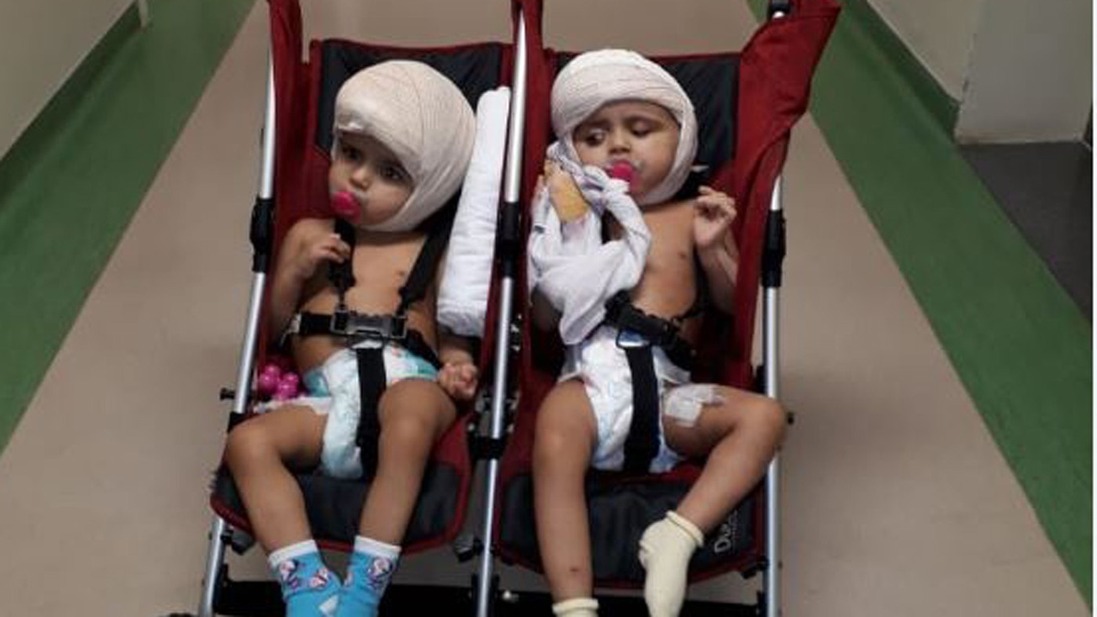 Após cirurgia de enxerto na nuca, bebê separada da irmã passa bem