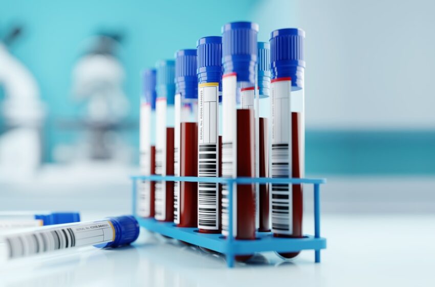  Exame de sangue mostra potencial para detectar câncer testicular 